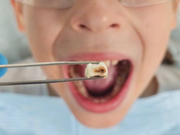 Best Emergency Tooth Extraction in Tampa, FL