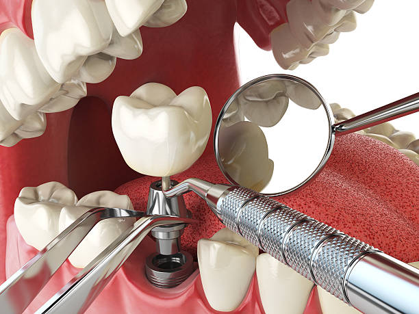 Best Emergency Root Canal Treatment in Tampa, FL